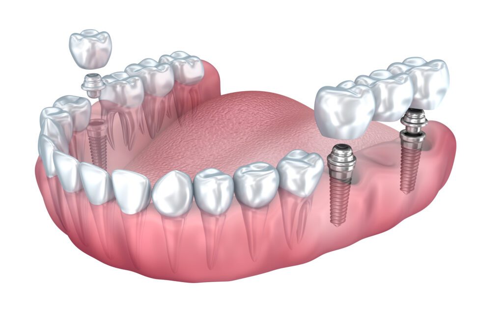 dental implants in Dallas, TX at East Quarter Dental